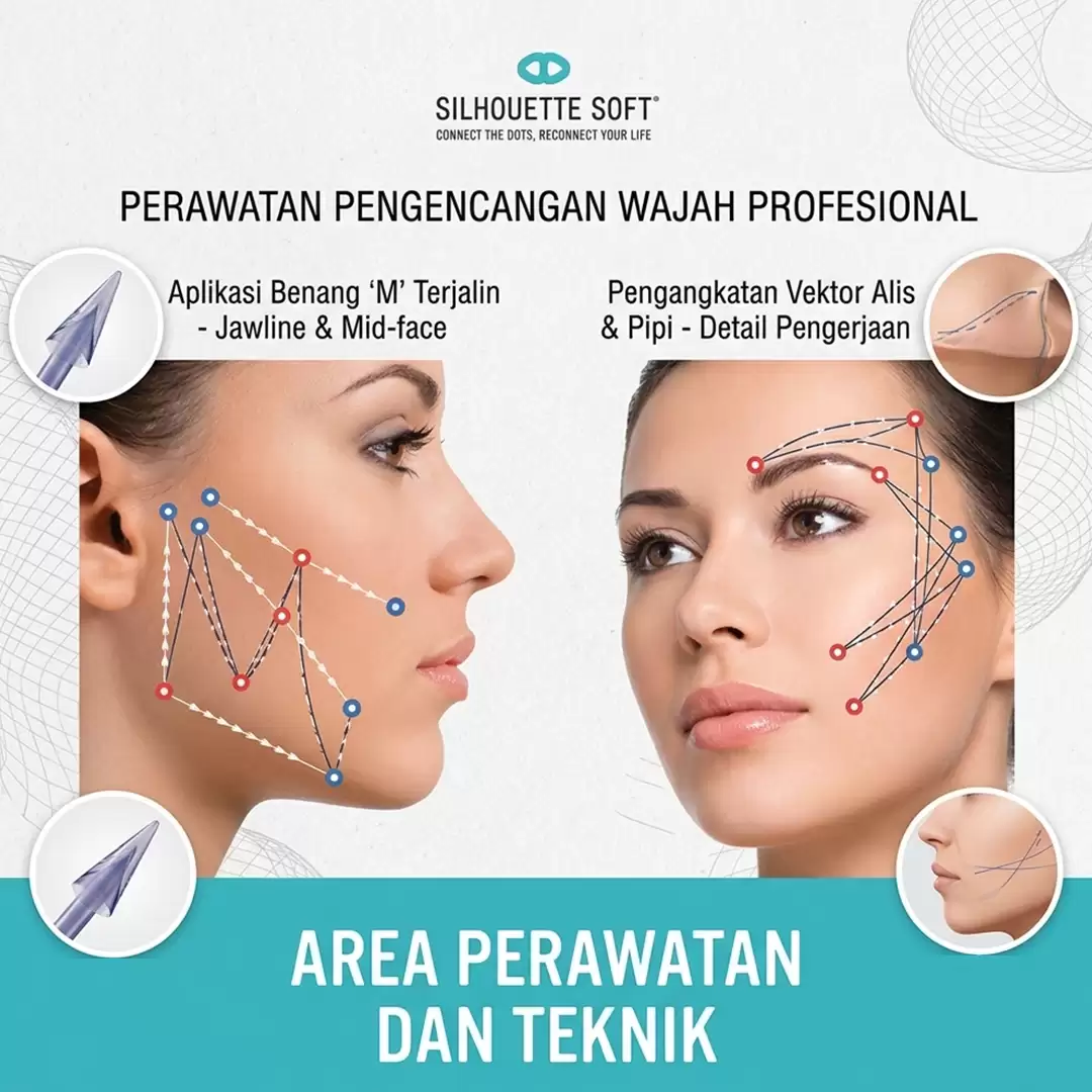 Personalisasi Thread Lift, Menentukan Teknik Benang yang Tepat Sesuai Kebutuhan Kulit