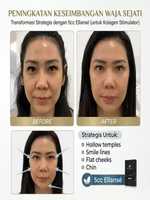 Pendekatan Strategis Mengatasi Hollow Temples hingga Flat Cheeks