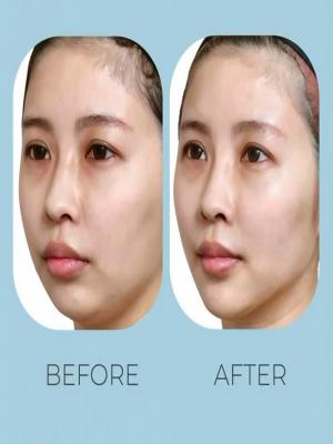 Thread Lift atau Filler?